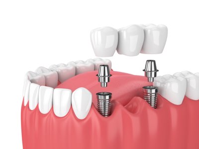 Bridge Implants