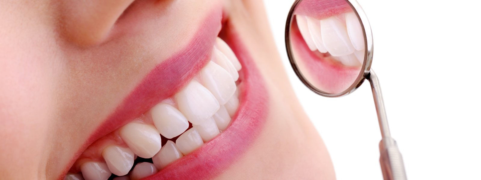 Dental Veneers in Dieppe or Moncton Dental Veneers in Dieppe or Moncton